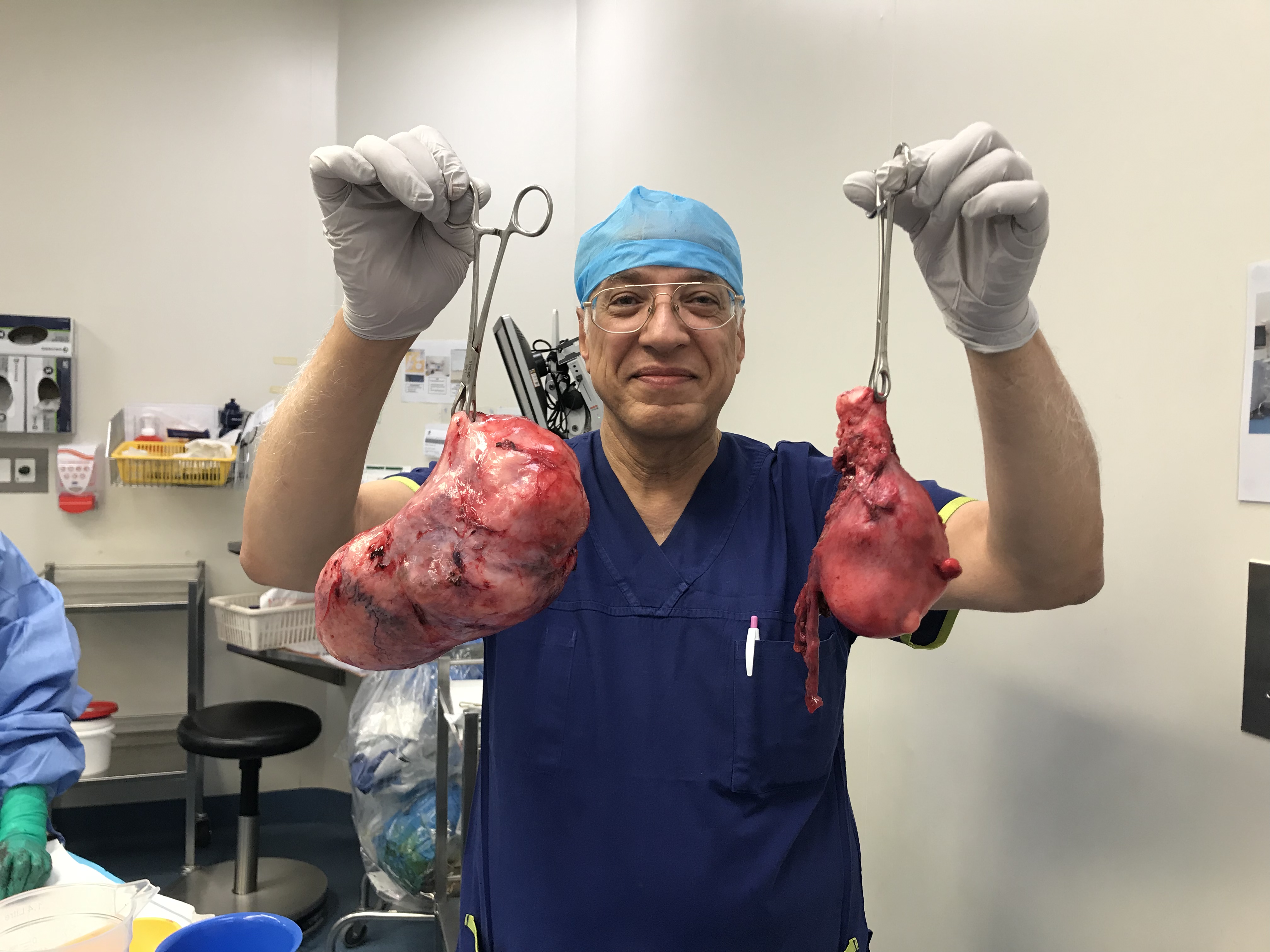 Dr Serag Youssif Fibroid Very Large Herniating Through Pelvic Floor5